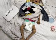 ‎Kasus Malnutrisi Berat Balita di Gaza City Melonjak Tiga Kali Lipat dalam Dua Minggu  ‎